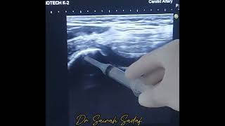 intraarticular Knee injection for OA knee joint by Dr Sairah Sadaf [upl. by Hyman]