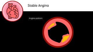 Stable Angina [upl. by Andre118]