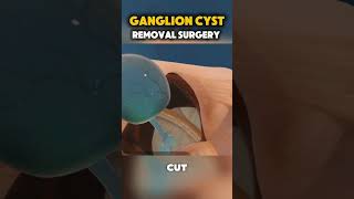 Ganglion Cyst Removal Surgery medical medical3danimation [upl. by Latouche]