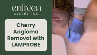 Cherry Angioma Removal with LAMPROBE [upl. by Sikram]