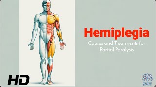 Hemiplegia 101 Identifying Causes and Exploring Effective Therapies [upl. by Nnyletak]