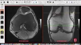 Systematic Interpretation of Knee MRI How I do it [upl. by Pry862]