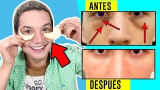 COMO QUITAR LAS OJERAS OSCURAS Y BOLSAS DE OJOS RÁPIDO CON REMEDIOS CASEROS  AndyZaturno [upl. by Milburn]