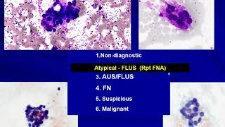 Thyroid Cytology I Approach [upl. by Repooc]