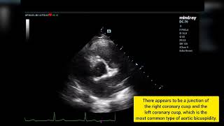 Válvula aórtica bicúspide Ecocardiograma tt  Bicuspid aortic valve on Transthoracic Echocardiogram [upl. by Janette]