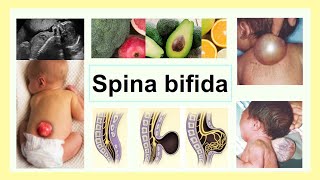 spina bifida [upl. by Nonnel984]