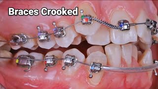 Braces crooked teeth transformation [upl. by Dilly629]