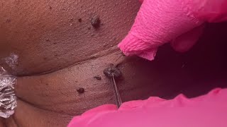 Skin Tag Removal [upl. by Madelaine]