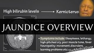 Jaundice Overview  Definition and Pathology Including neonatal jaundice [upl. by Novick]