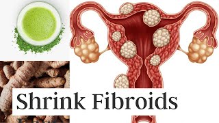 3 Ways to Shrink Fibroids Naturally Without Surgery [upl. by Yerg]