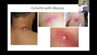 Diagnosis and Treatment of Cellulitis [upl. by Yrevi]