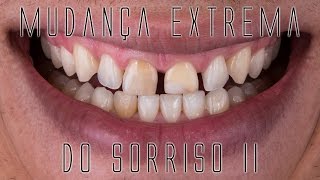 Mudança extrema do sorriso II Os bastidores das facetas e lentes de contato dentais [upl. by Anaej]