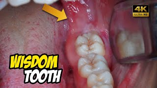 Removal of horizontal impacted wisdom tooth  Odontectomy  Dentist  Dokter Gigi Tri Putra [upl. by Indira]