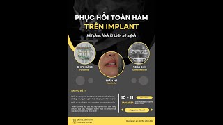 Pterygoid amp transnasal implant planning with Realguide [upl. by Gader]