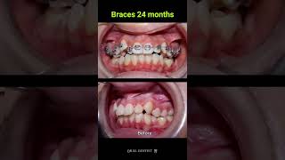 24 months Braces Transformation ‼️👏 dentalcare satisfying dentist dentalhealth shorts [upl. by Oiciruam31]