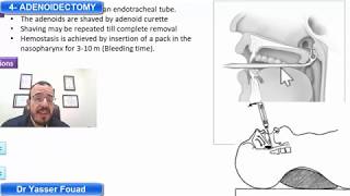 4 adenoidectomy [upl. by Adnaral]