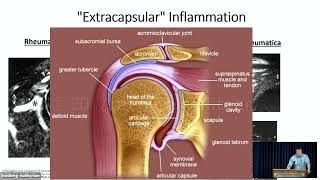 Polymyalgia Rheumatica What has changed since 1957 [upl. by Burkhardt]