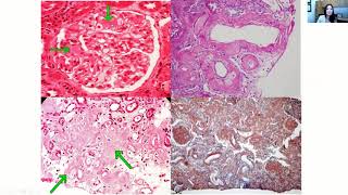 Renal Amyloidosis Presentations Diagnosis and Management [upl. by Lleznod]