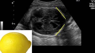 Ecografía del Sistema Nervioso Central fetal FACIL Parte 2 [upl. by Jahdai]