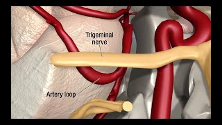 Treatment for Trigeminal Neuralgia UCSF Neurosurgery [upl. by Jesh]