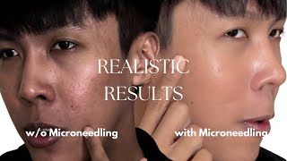 Lets do Microneedling on half of my face  Acne scars treatment [upl. by Los]