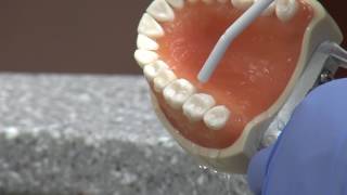 New cavity treatment offers no drilling no filling [upl. by Nueovas709]