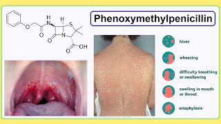 phenoxymethylpenicillin [upl. by Anuqahs991]