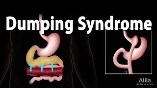 Dumping Syndrome Animation [upl. by Mazurek]