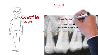 The new periodontal classification MUST WATCH FOR ALL DENTISTS [upl. by Atekan]