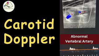 Carotid amp Vertebral Doppler  Carotid Atheroma Abnormal VA  Case story [upl. by Eseyt563]