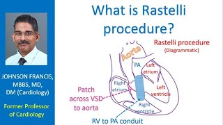 What is Rastelli procedure [upl. by Ayouqes]