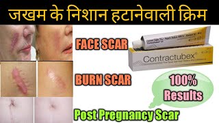 Contractubex Gel review पुराने से पुराने scars Marks को जड़ से मिटा देता है ये जेल।। [upl. by Jocelyne736]