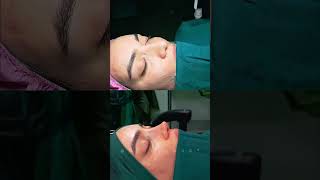 CONTOURING NOSE SURGERY RESULTS [upl. by Giacamo900]