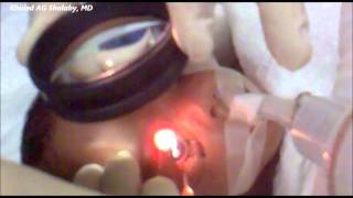 Laser Treatment of Retinopathy of prematurity ROP [upl. by Yuhas]