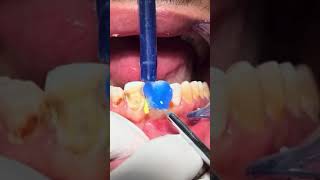 Deep Caries removal🦷😱😱😱 watch full video [upl. by Haraz]