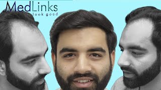 MedLinks Hair Transplant Results  Before and After Hair Transplant Results  Dr Gaurang Krishna [upl. by Seppala]