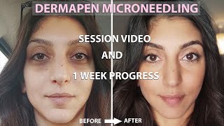 Dermapen Microneedling Before And After  Process  1 Week Amazing Results [upl. by Eatnom]