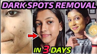 Remove DARK SPOTS NATURALLY in 3 Days 😍 Hyperpigmentation Acne Scars Brown Spots [upl. by Eelanna]