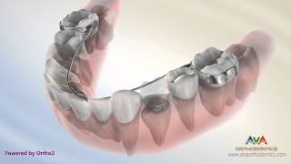 Orthodontic Space Management  Lingual Arch Appliance [upl. by Nosduj]