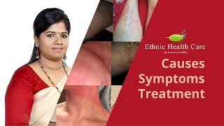 ஆண்களுக்கு ஏற்படும் தோல் நோய் எக்ஸிமாகரப்பான் நோய்அரிப்பு Skin Problem Eczema Karappan Disease [upl. by Jonathan123]