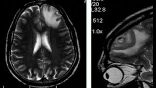 TMT NeuroRadiology CNS Infections Part II [upl. by Anuat]