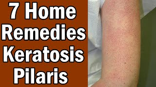 7 Home Remedies For Keratosis Pilaris [upl. by Nattie533]