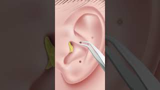 ASMR Ear Cleaning Animation  Oddly Satisfying ear stone removal  shorts [upl. by Anilam]