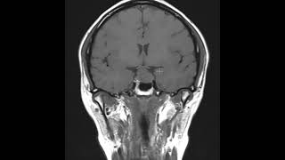 Pituitary macroademoma that compresses the optic chiasm [upl. by Hagai]