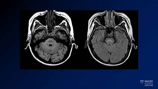 Neuroradiology board review lecture 1 case 19 [upl. by Dania]