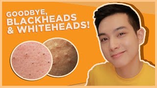 BEST SKINCARE for BLACKHEADS amp WHITEHEADS OPEN amp CLOSED COMEDONES  Jan Angelo [upl. by Irrak]