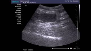 Liposarcoma of soft tissues [upl. by Eleirbag]