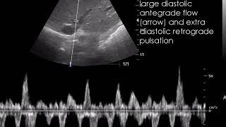 CASE 711 Congestive hepatopathy Chronic passive congestion [upl. by Sylirama524]