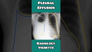 Pleural effusion made simple for USMLE NEET PG NCLEX neet usmle neetpg mbbs doctor [upl. by Etolas]