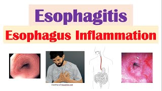 Esophagitis Esophagus Inflammation Causes Risk Factors Signs and Symptoms Diagnosis Treatment [upl. by Enelam644]